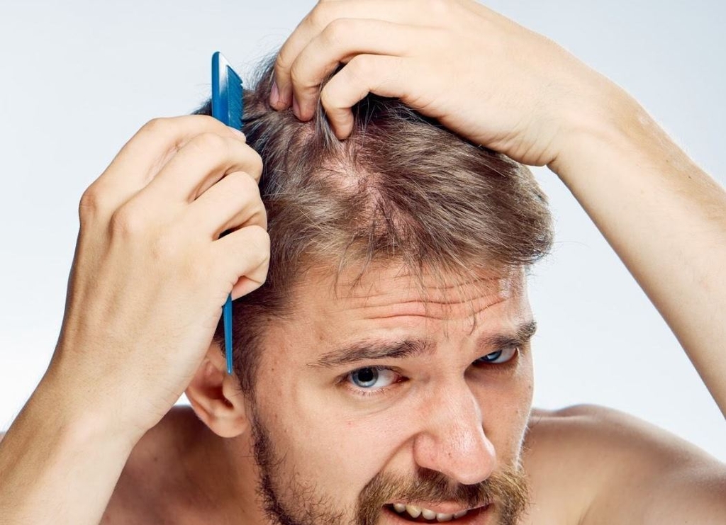Nguyên nhân rụng tóc ở nam giới