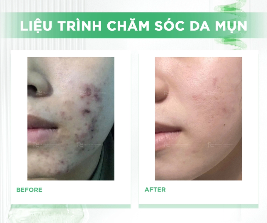 Liệu trình HISTOLAB — Sau