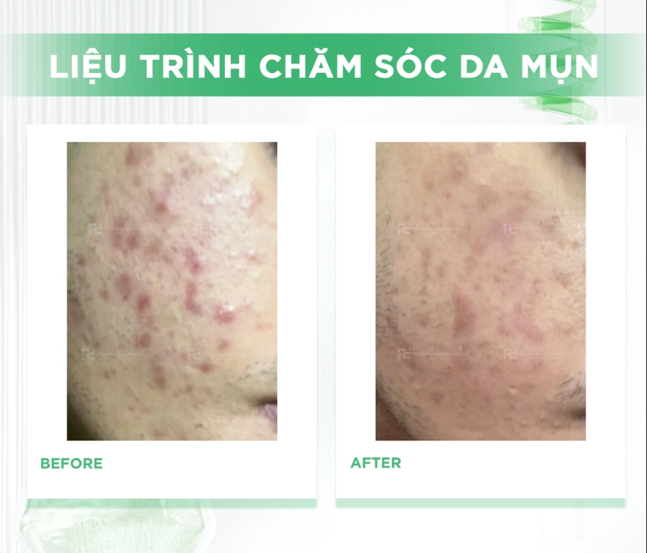 Liệu trình HISTOLAB — Trước & Sau