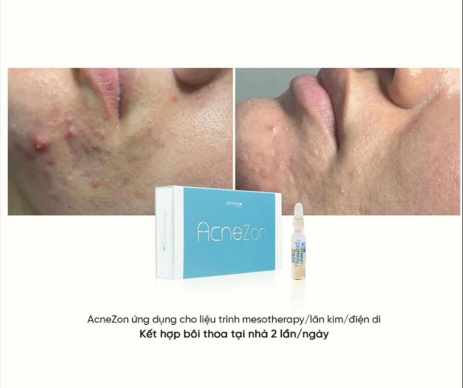 Liệu trình DERMICA ACNEZON — Trước & Sau