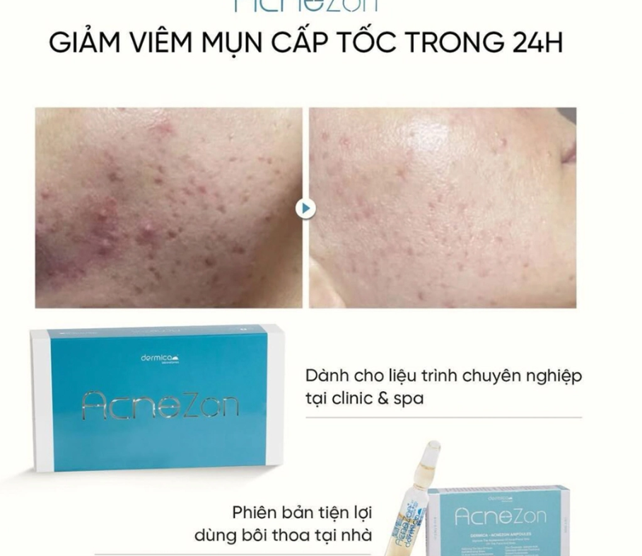 Liệu trình DERMICA ACNEZON — Sau