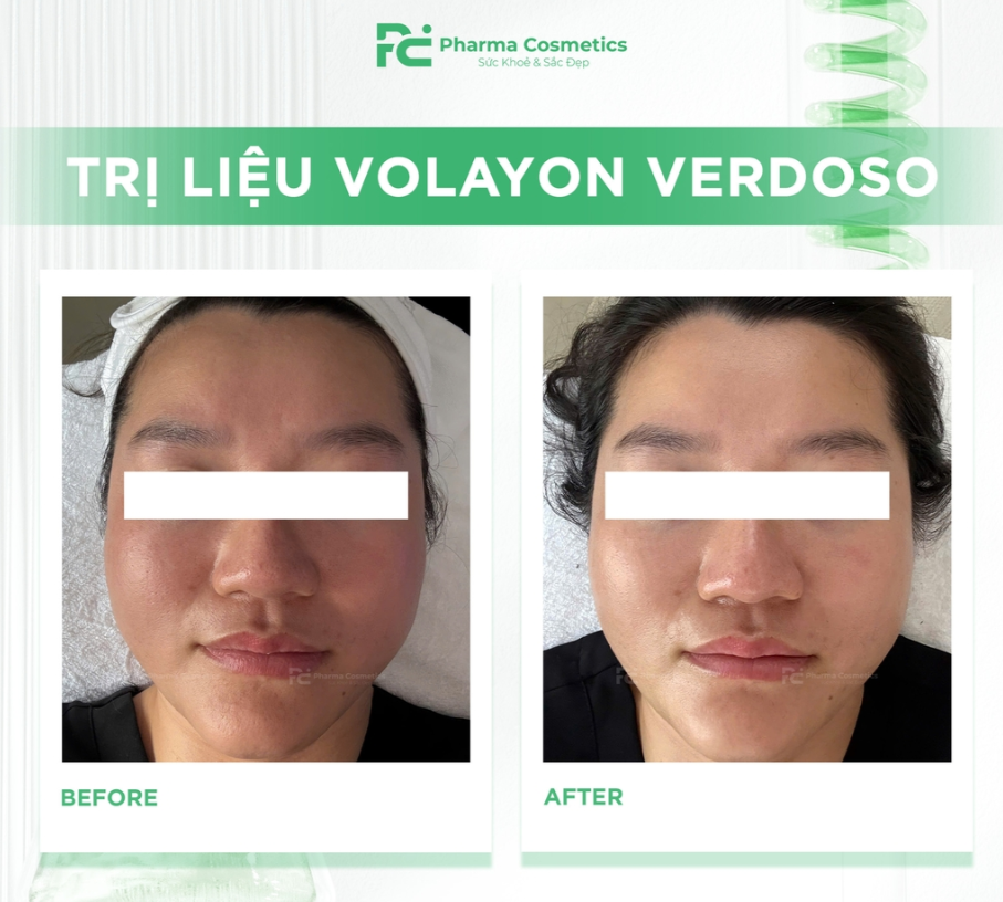 Liệu trình Volayon Verdoso — Trước & Sau