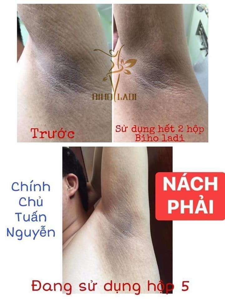 Biho Ladi 5S Siêu dưỡng thâm - Đặc trị thâm hôi