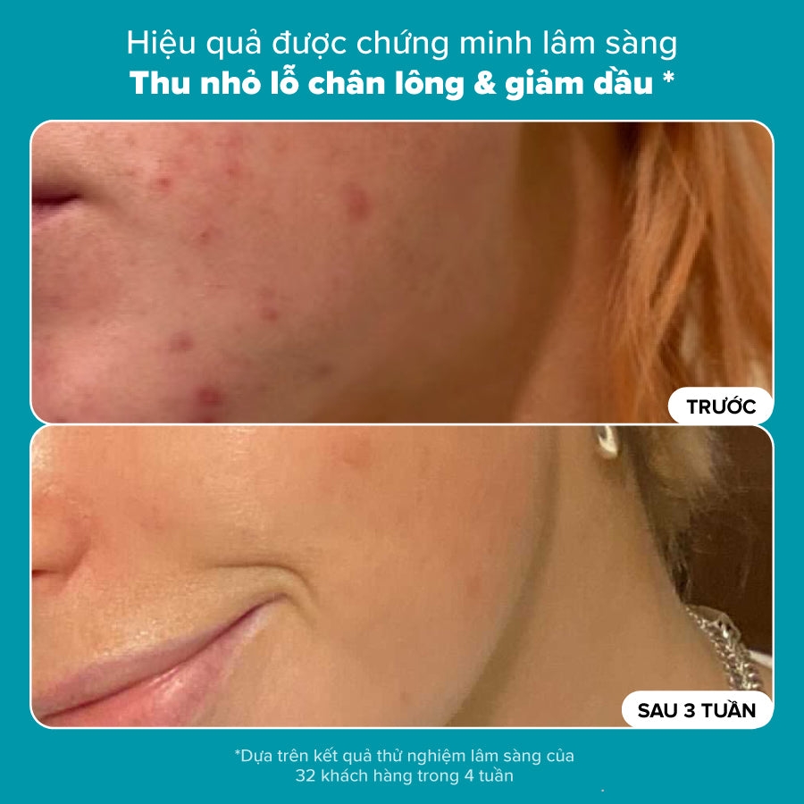 Dung dịch loại bỏ tế bào chết Skin Perfecting 2% BHA Liquid Exfoliant
