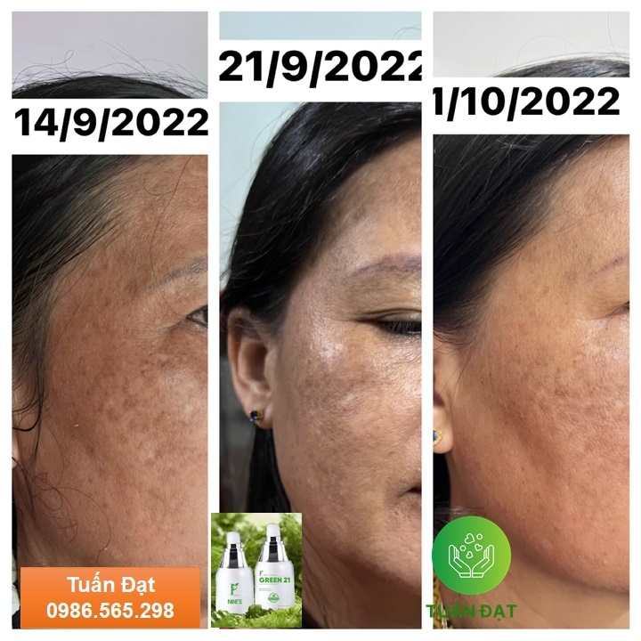 Melasma Green 21 Hỗ trợ trị nám hiệu quả công nghệ thủy phân đa tầng sắc tố tiên tiến từ Nhật Bản