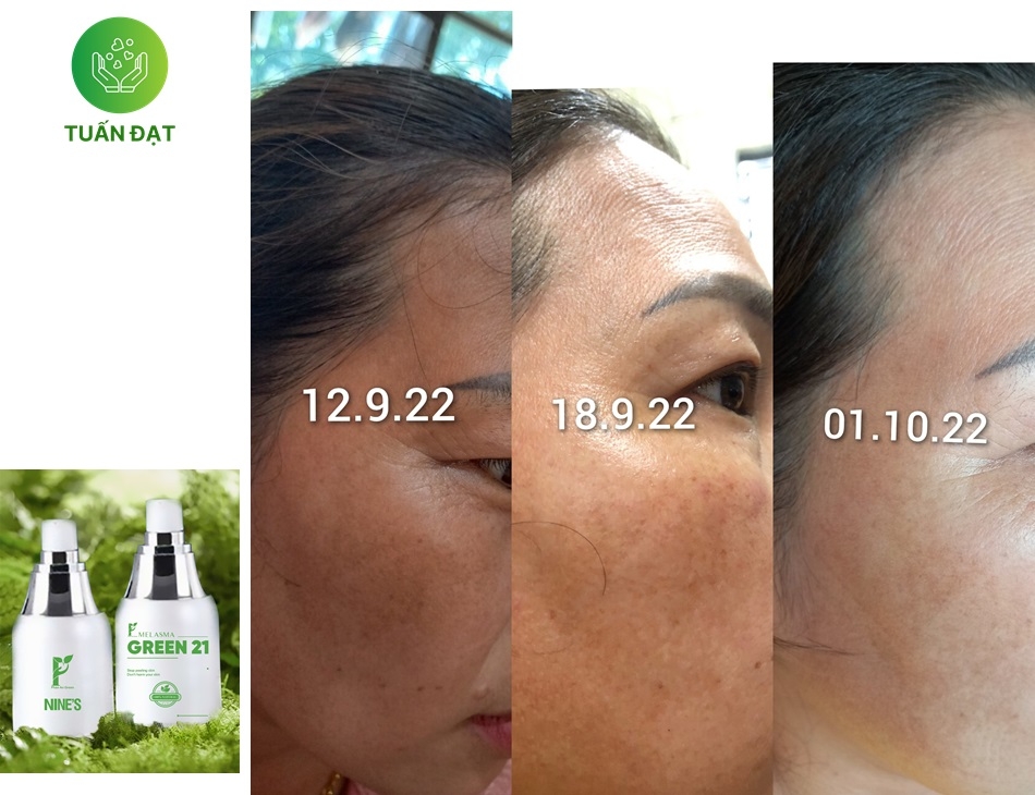 Melasma Green 21 Hỗ trợ trị nám hiệu quả công nghệ thủy phân đa tầng sắc tố tiên tiến từ Nhật Bản