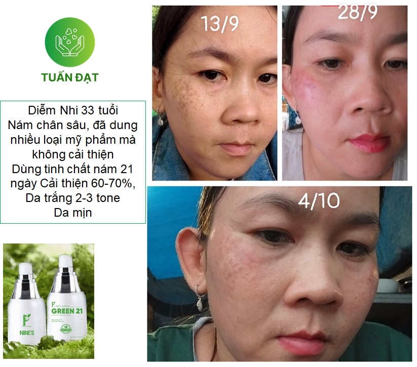 Melasma Green 21 Hỗ trợ trị nám hiệu quả công nghệ thủy phân đa tầng sắc tố tiên tiến từ Nhật Bản