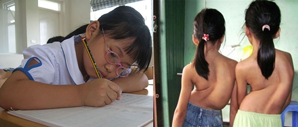ngồi học sai tư thế gây cong vẹo cột sống