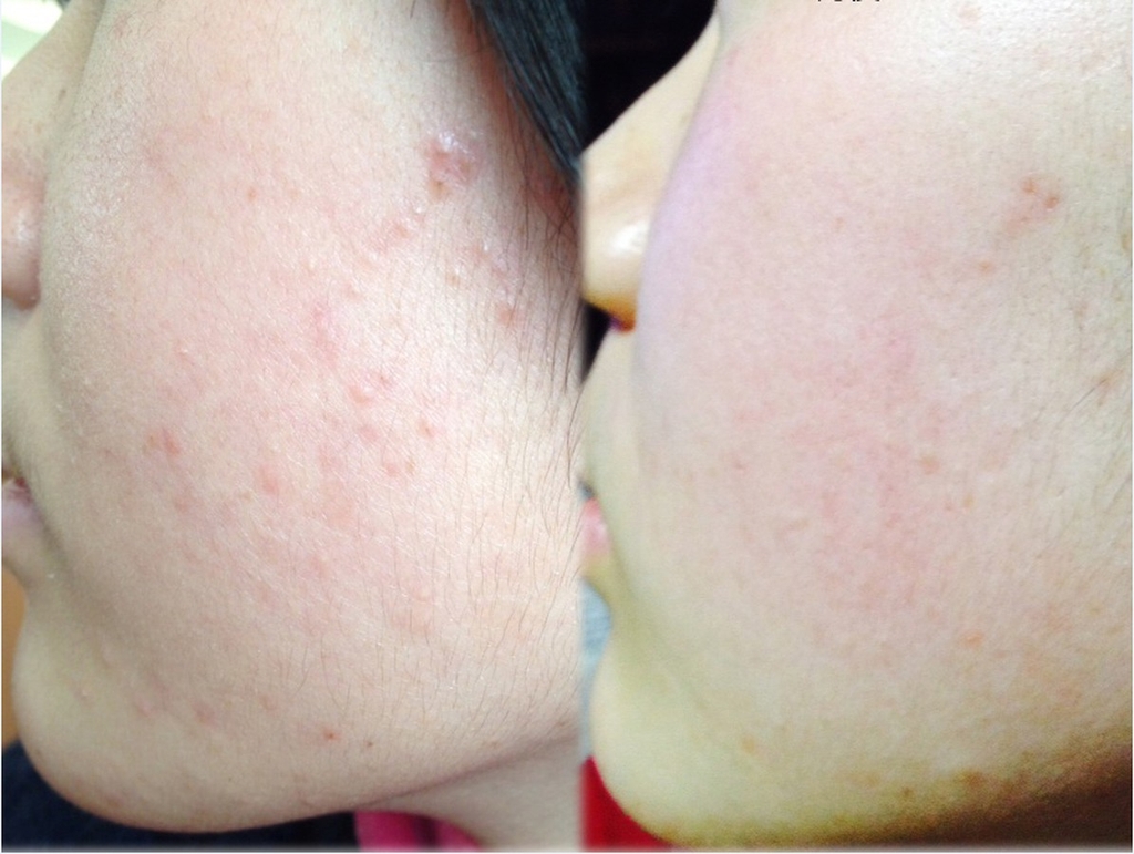 Kem Trị Mụn Pair Nhật Bản - Trị Mụn Hiệu Quả, Nhanh Chóng