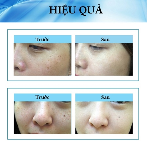 Kem Trị Nám Tàn Nhang Kobayashi Sobana C Nhật Bản Chính Hãng