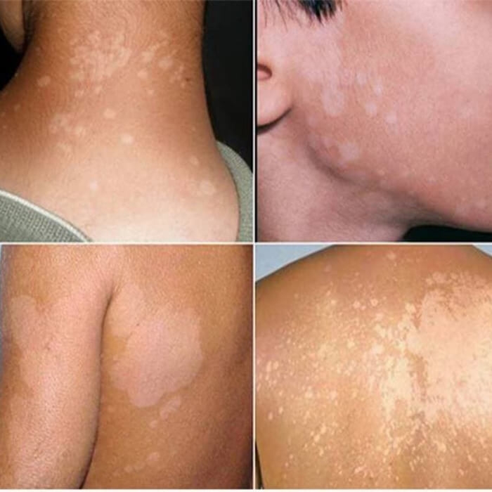 Nước Xịt Lang Ben Hồng Sơn 50ml