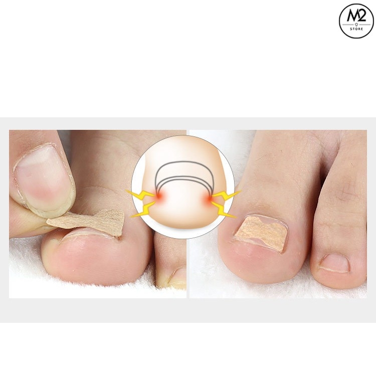 Miếng Dán Điều Chỉnh, Hỗ Trợ Móng Chân Mọc Ngược Tiện Dụng XIMO MD02