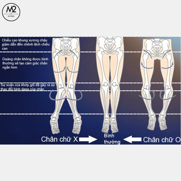 Đai Nẹp Chỉnh Hình Chân Vòng Kiềng X/O Jorilano Chính Hãng DCHVK04
