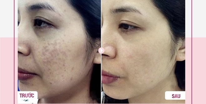 trị nám bằng laser picosure có tốt không