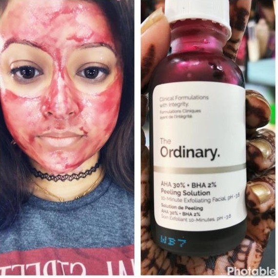 Serum tẩy tế bào chết hoá học The Ordinary AHA 30%+ BHA 2% Peeling Solution