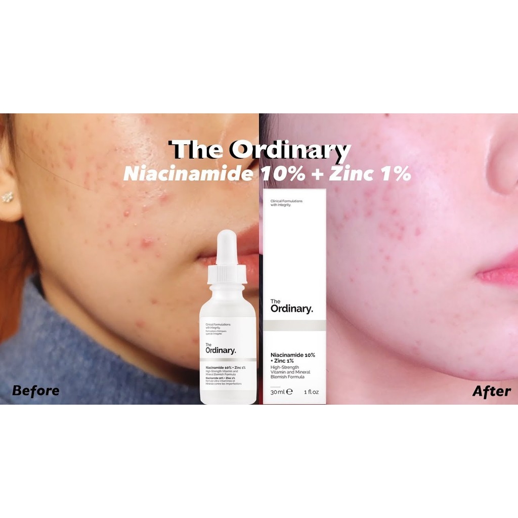 Serum dưỡng da làm mờ thâm mụn The Ordinary Niacinamide 10% + Zinc 1%