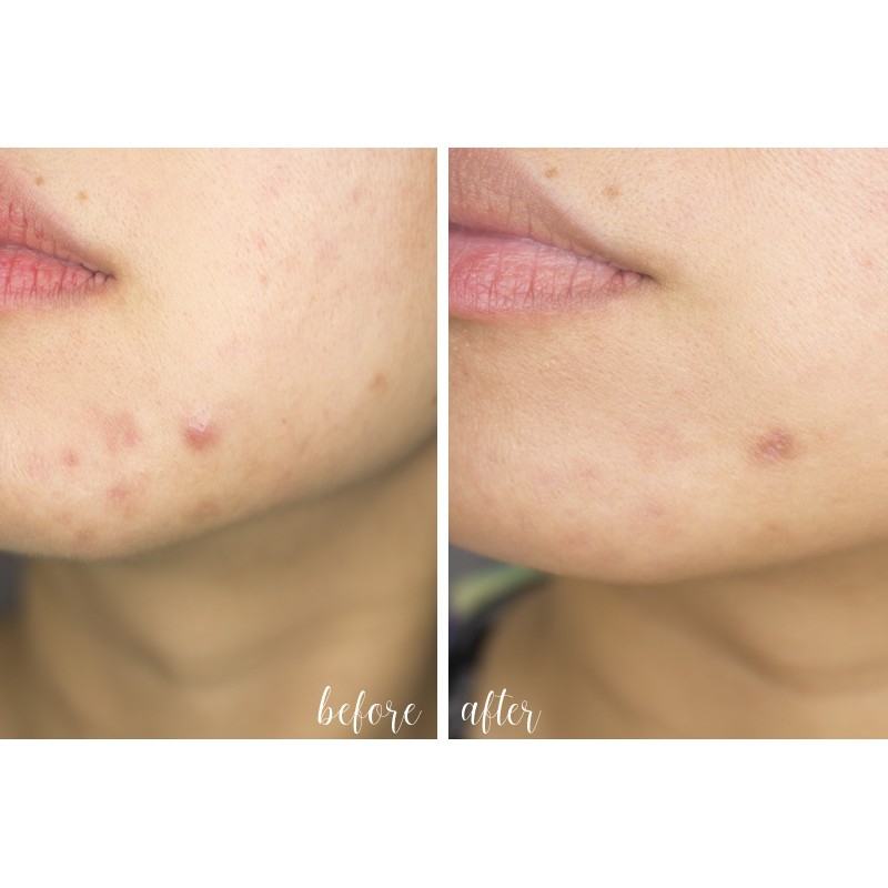 SRM Zapzyt Acne Wash Cleanser