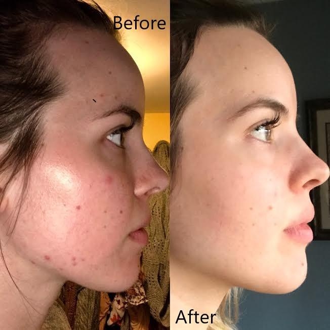 Gel giảm mụn Differin Adapalene 0.1%