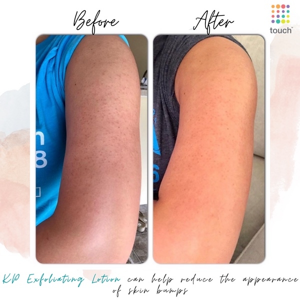 Kem dưỡng làm mịn da Gold Bond Rough & Bumpy skin 226g