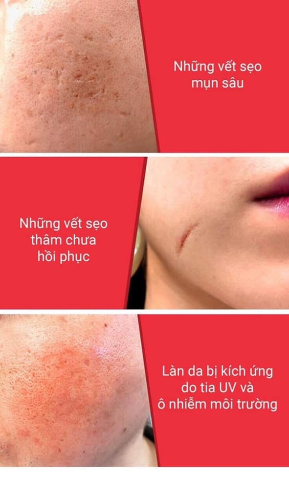 Tinh chất ốc sên đen giảm sẹo lõm - sẹo mụn Some By Mi Snail Truecica Miracle Serum