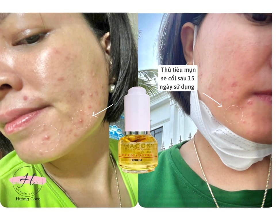 Bộ trị mụn Kem Thảo Dược & serum Macon