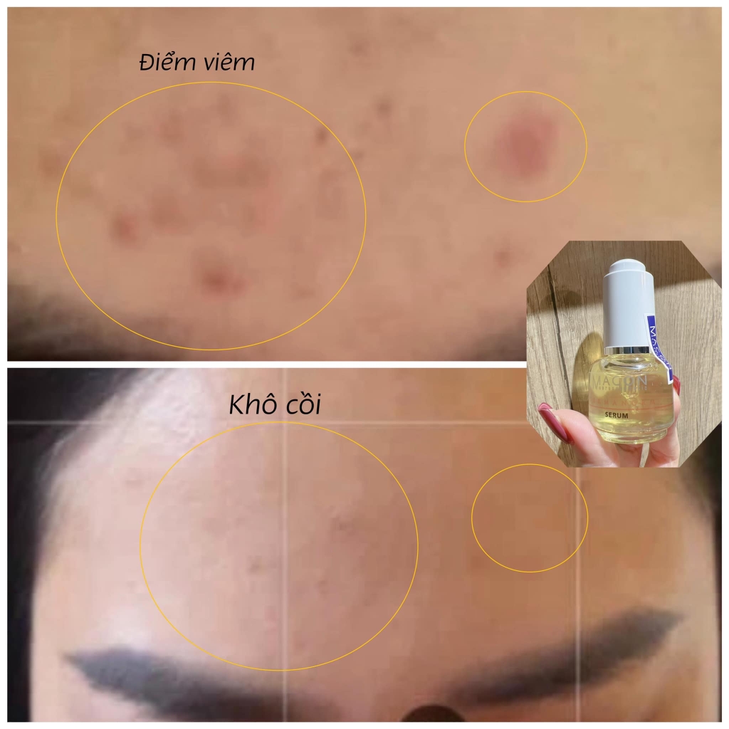 Bộ trị mụn Kem Thảo Dược & serum Macon