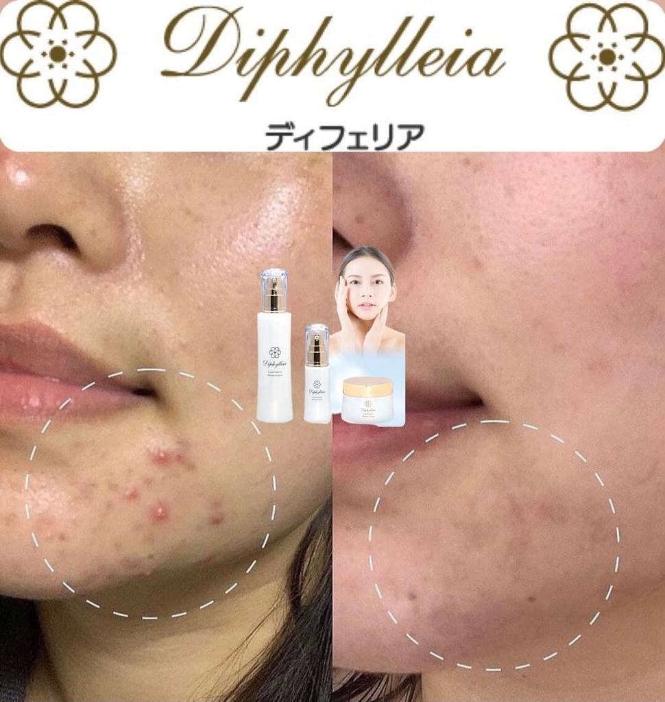 DIPHYLLEIA- CẤP ẨM, GIẢM MỤN, TÁI TẠO DA KHỎE MẠNH