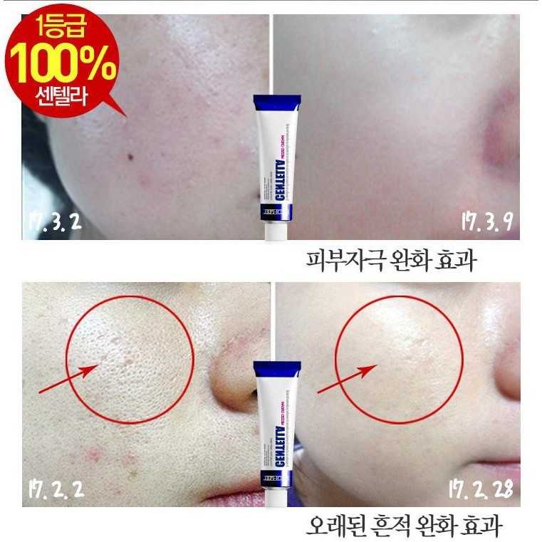 KEM TRỊ MỤN CENTELLA MEDI-PE-hàn