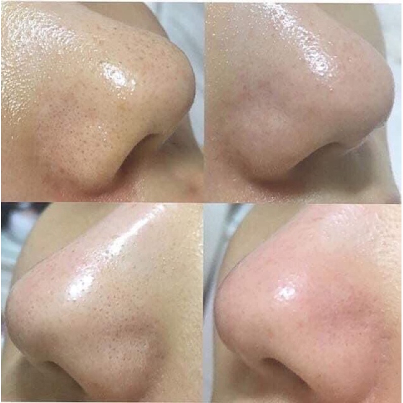 Ủ mụn đầu đen MEDI-PEEL Extra Super - 1000ml-hàn