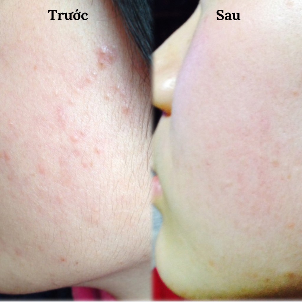 Kem Trị Mụn Pair Nhật Bản 24g