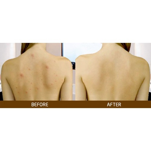 Sữa tắm A-derma giảm mụn lưng, viêm lỗ chân lông Aderma 500ml-pháp