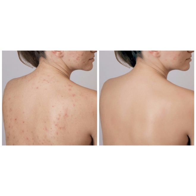 Sữa tắm A-derma giảm mụn lưng, viêm lỗ chân lông Aderma 500ml-pháp