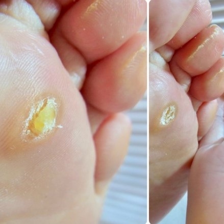 Thuốc đặc trị MỤN CÓC, MỤN CƠM, MỤN THỊT, NỐT RUỒI, MẮT CÁ CHÂN,THỊT THỪA..