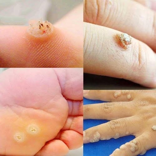 Thuốc đặc trị MỤN CÓC, MỤN CƠM, MỤN THỊT, NỐT RUỒI, MẮT CÁ CHÂN,THỊT THỪA..