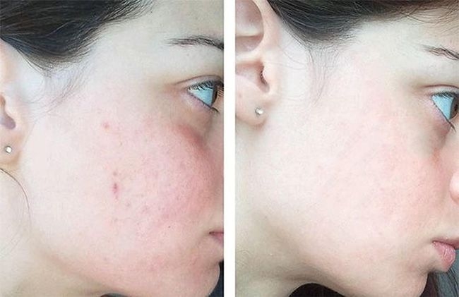 Nước Hoa Hồng Trị Mụn Meishoku - CHAI LỚN 90ML-nhật