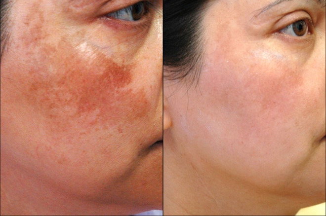 Bộ trị nám tàn nhang cao cấp - KAYOKO VÀNG Mẫu Mới 6SP-nhật