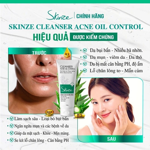 SỮA RỬA MẶT SKINZE ACNE OIL CONTROL CHO DA DẦU MỤN TRÀM TRÀ TRẦU KHÔNG KHỔ QUA BHA VITAMIN B5