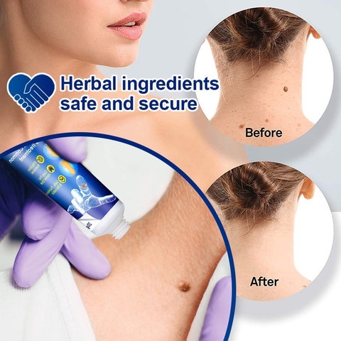 KEM TẨY MỤN CÓC, MỤN THỊT, DƯỠNG DA, KHÁNG KHUẨN TINH CHẤT THẢO DƯỢC THIÊN NHIÊN AN TOÀN NHƯNG PHÍ CỰC RẼ - GDN