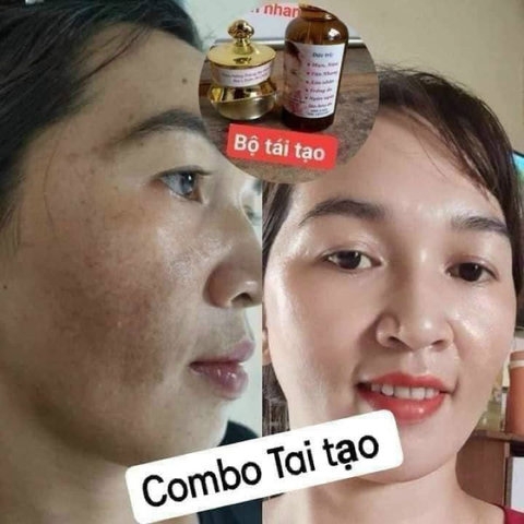 COMBO KEM TRỊ NÁM , KEM DƯỠNG HỔ TRỢ TÁI TẠO DA ĐỐM NÂU, ĐỒI MỒI GIA TRUYỀN - GDN