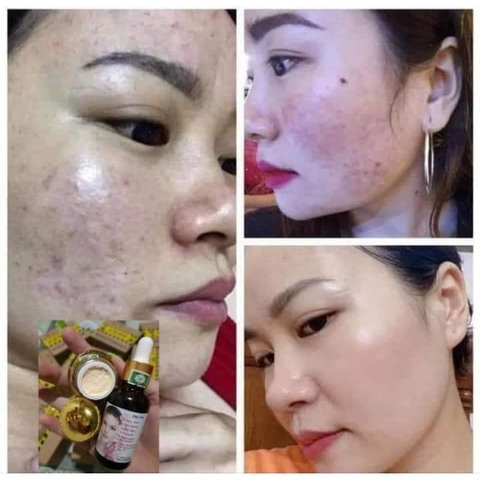 COMBO KEM TRỊ NÁM , KEM DƯỠNG HỔ TRỢ TÁI TẠO DA ĐỐM NÂU, ĐỒI MỒI GIA TRUYỀN - GDN