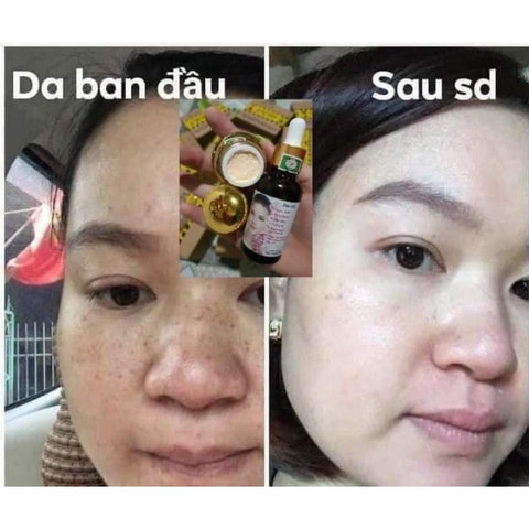 COMBO KEM TRỊ NÁM , KEM DƯỠNG HỔ TRỢ TÁI TẠO DA ĐỐM NÂU, ĐỒI MỒI GIA TRUYỀN - GDN