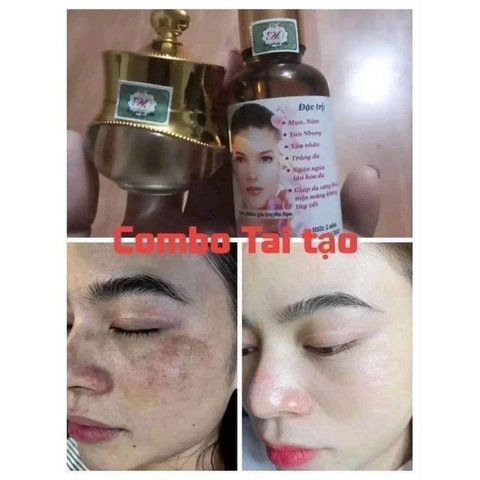 COMBO KEM TRỊ NÁM , KEM DƯỠNG HỔ TRỢ TÁI TẠO DA ĐỐM NÂU, ĐỒI MỒI GIA TRUYỀN - GDN