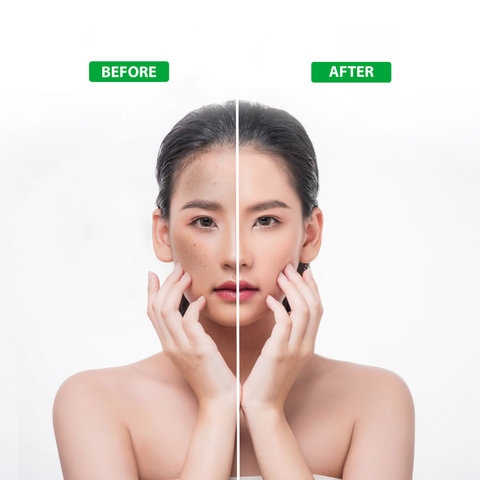 XỊT KHOÁNG GIÚP CẤP ẨM SÁNG DA TỪ THIÊN NHIÊN ACNEVIR SANTAFA - CHAI 100ML3 - SANTAFA