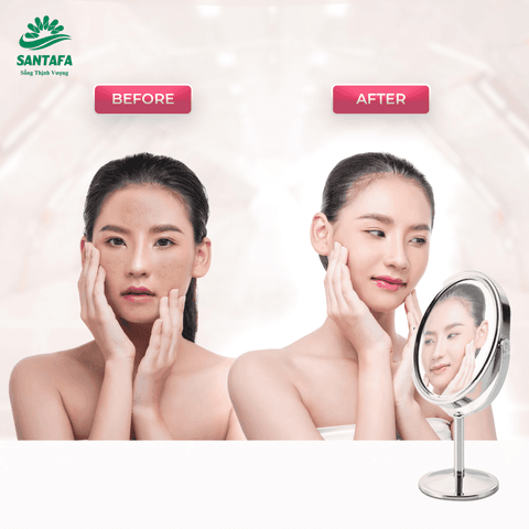 KEM GIẢM MỤN ĐẦU ĐEN, MỤN CÁM ACNEVIR SANTAFA THÀNH PHẦN THIÊN NHIÊN TUÝP 10GR - SANTAFA