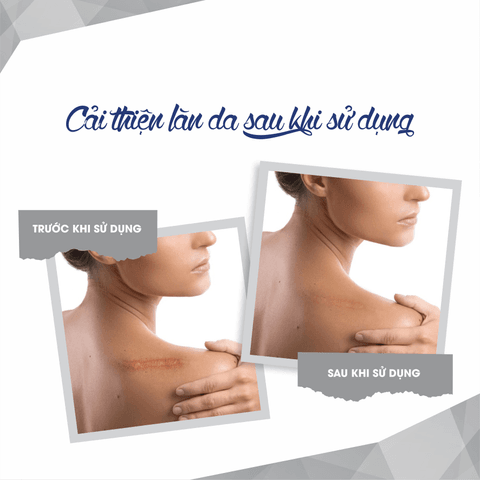 GEL LÀM MỜ SẸO SCAR GEL -FIXDERMA DO MỤN, BỎNG, RẠN DA, VẾT THƯƠNG (TUÝP 7ML)
