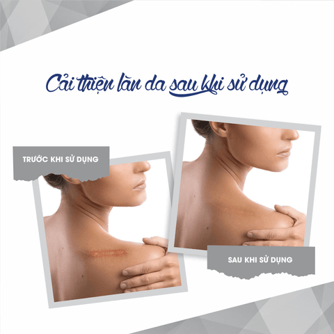 GEL LÀM MỜ SẸO SCAR GEL -FIXDERMA DO MỤN, BỎNG, RẠN DA, VẾT THƯƠNG (TUÝP 15ML)