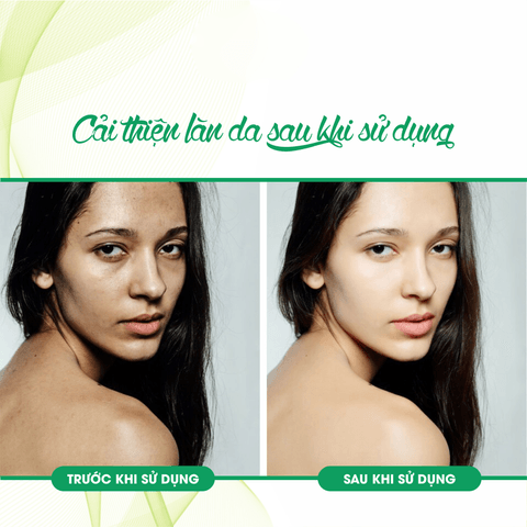 KEM DƯỠNG ẨM GIÚP DA MỀM MẠI CLEOVERA CREAM -FIXDERMA TUÝP 60G