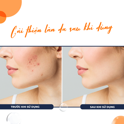 GEL GIÚP TRỊ MỤN, KHÁNG KHUẨN, KIỂM SOÁT DẦU NHỜN BAN NGÀY SALYZAP GEL FOR ACNE DAY TIME-FIXDERMA TUÝP 20G