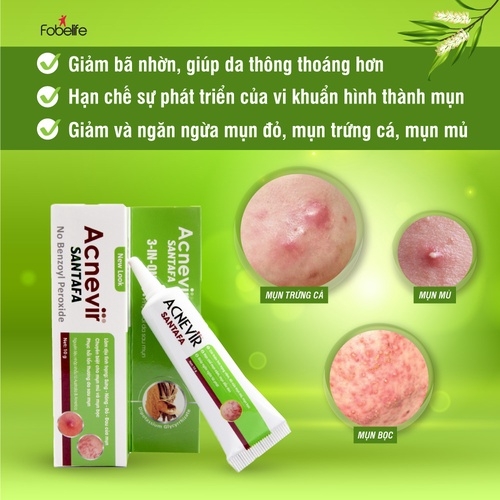 KEM TRỊ MỤN BỌC, MỤN MỦ ACNEVIR (XANH) - SANTAFA