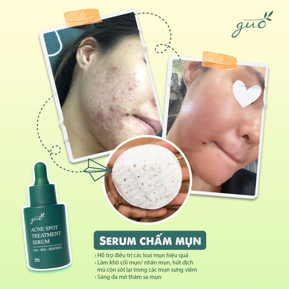 SERUM CHẤM MỤN, GOM KHÔ CỒI, GIẢM MỤN, MỜ THÂM - 100% FEEDBACK KHÁCH HÀNG TIN DÙNG HIỆU QUẢ - GUO